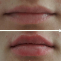 До и сразу после процедуры увеличения губ