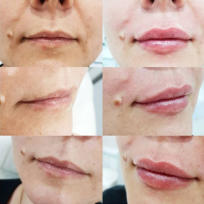 Введено 1 мл геля Juvederm Ultra 3. Пациентка очень довольна!