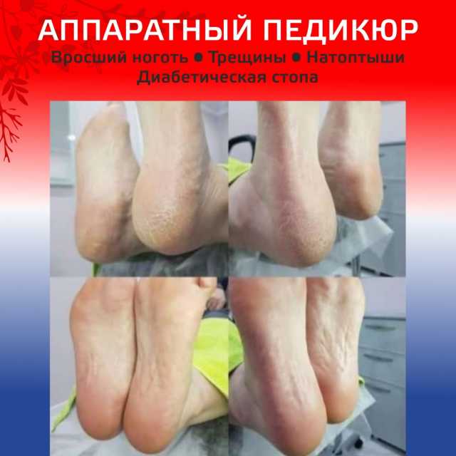 Аппаратный педикюр