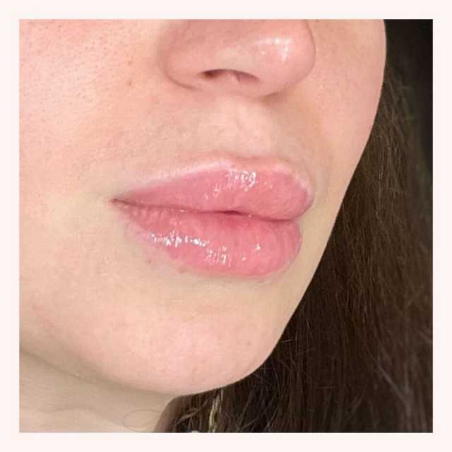 Коррекция формы губ