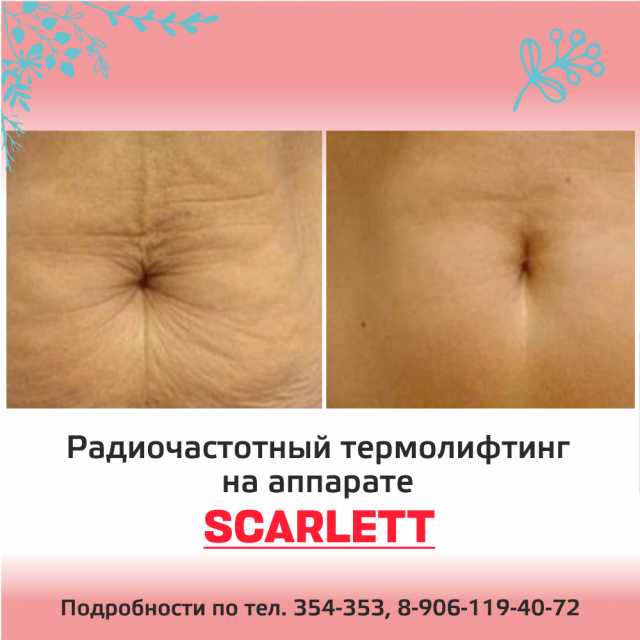 RF-Лифтинг кожи на аппарате Scarlet S