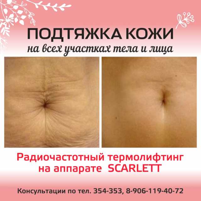 Подтяжка кожи на всех участках тела и лица